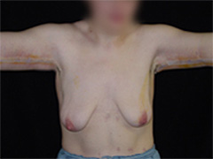 brachioplastie chirurgie esthétique des bras photo avant après