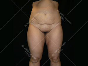 Lipoaspiration de l'abdomen avant après — Dr Weiss Paris (cas 5)