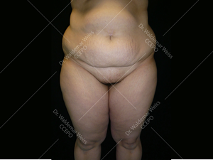 Lipoaspiration de l'abdomen avant après — Dr Weiss Paris (cas 5)
