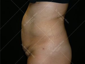 Lipoaspiration de l'abdomen avant après — Dr Weiss Paris (cas 6)