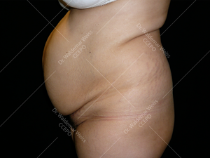 Lipoaspiration de l'abdomen avant après — Dr Weiss Paris (cas 6)