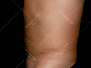 Lipoaspiration de l'abdomen avant après — Dr Weiss Paris (cas 7)