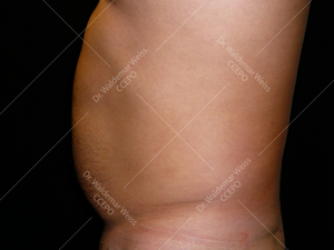 Lipoaspiration de l'abdomen avant après — Dr Weiss Paris (cas 7)