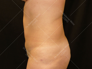 Lipoaspiration de l'abdomen avant après — Dr Weiss Paris (cas 8)