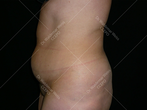 Lipoaspiration de l'abdomen avant après — Dr Weiss Paris (cas 8)