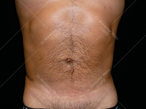 Lipoaspiration de l'abdomen avant après — Dr Weiss Paris (cas 9)