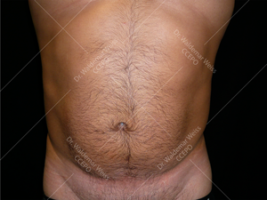 Lipoaspiration de l'abdomen avant après — Dr Weiss Paris (cas 9)