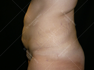 Lipoaspiration de l'abdomen avant après — Dr Weiss Paris (cas 10)