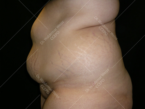 Lipoaspiration de l'abdomen avant après — Dr Weiss Paris (cas 10)