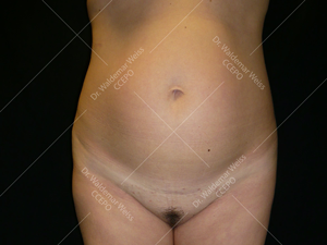 Lipoaspiration de l'abdomen avant après — Dr Weiss Paris (cas 11)
