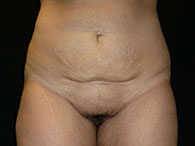 lipoaspiration photo avant après chirurgie esthétique de l'abdomen