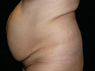 chirurgie esthétique du ventre photo avant après lipoaspiration abdominale