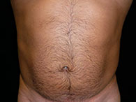 photo avant après lipoaspiration abdominale chirurgie esthétique du ventre