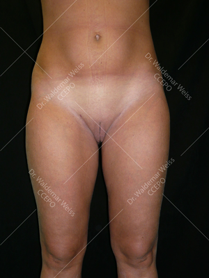 Lipoaspiration des cuisses avant après — Dr Weiss Paris (cas 7)