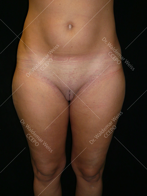 Lipoaspiration des cuisses avant après — Dr Weiss Paris (cas 7)