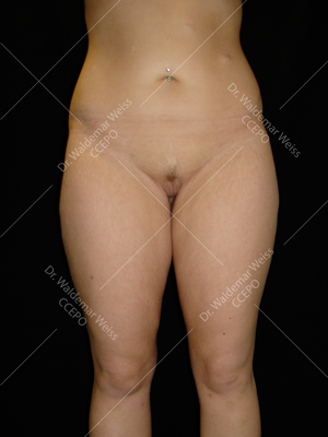 Lipoaspiration des cuisses avant après — Dr Weiss Paris (cas 3)