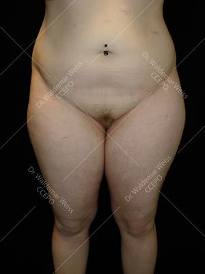 Lipoaspiration des cuisses avant après — Dr Weiss Paris (cas 3)