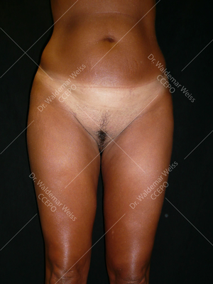 Lipoaspiration des cuisses avant après — Dr Weiss Paris (cas 5)