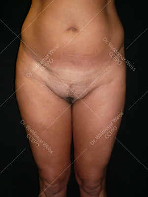 Lipoaspiration des cuisses avant après — Dr Weiss Paris (cas 5)