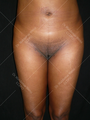 Lipoaspiration des cuisses avant après — Dr Weiss Paris (cas 4)