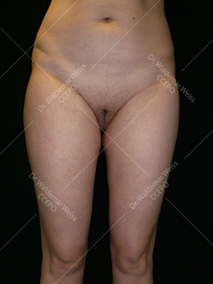 Lipoaspiration des cuisses avant après — Dr Weiss Paris (cas 9)