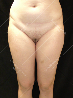 Lipoaspiration des cuisses avant après — Dr Weiss Paris (cas 9)