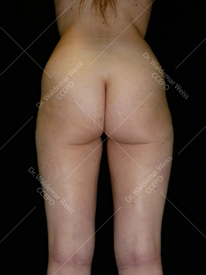 Lipoaspiration des fesses avant après — Dr Weiss Paris (cas 7)