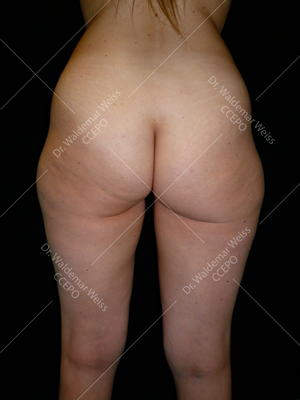 Lipoaspiration des fesses avant après — Dr Weiss Paris (cas 7)