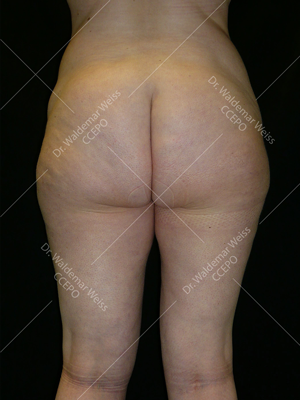 Lipoaspiration des fesses avant après — Dr Weiss Paris (cas 11)
