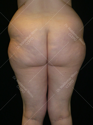 Lipoaspiration des fesses avant après — Dr Weiss Paris (cas 11)