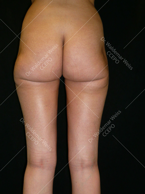 Lipoaspiration des fesses avant après — Dr Weiss Paris (cas 9)