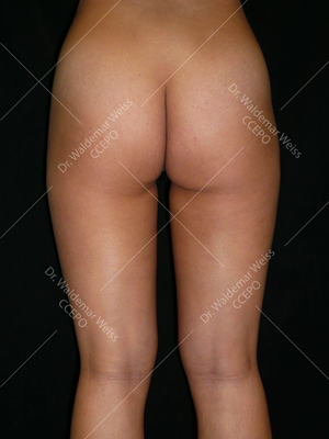 Lipoaspiration des fesses avant après — Dr Weiss Paris (cas 1)