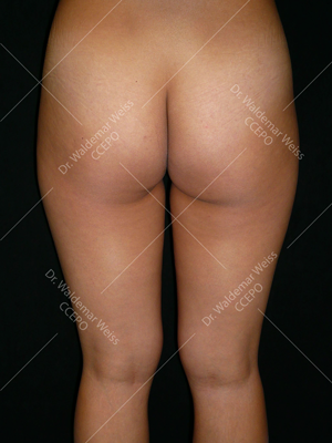 Lipoaspiration des fesses avant après — Dr Weiss Paris (cas 1)