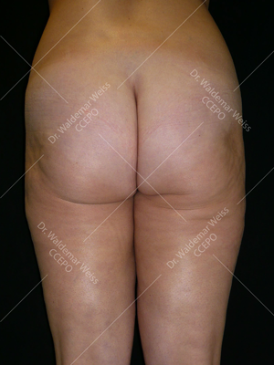 Lipoaspiration des fesses avant après — Dr Weiss Paris (cas 5)
