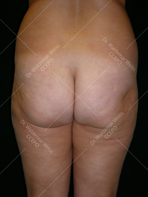Lipoaspiration des fesses avant après — Dr Weiss Paris (cas 5)