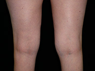 chirurgie esthétique des genoux lipoaspiration photo avant après