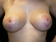 Remodelage mammaire et prothèse mammaire chirurgie esthétique seins ptosés photos avant après
