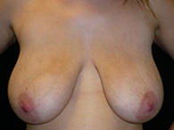 Remodelage mammaire et prothèse mammaire chirurgie esthétique seins ptosés photos avant après