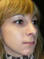 rhinoplastie avant après chirurgie esthétique nez Dr Weiss