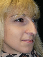 rhinoplastie avant après chirurgie esthétique nez Dr Weiss