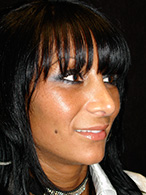 rhinoplastie avant après chirurgie esthétique nez Dr Weiss