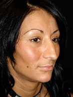 rhinoplastie avant après chirurgie esthétique nez Dr Weiss