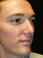 rhinoplastie avant après chirurgie esthétique nez Dr Weiss