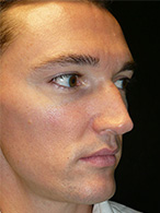 rhinoplastie avant après chirurgie esthétique nez Dr Weiss