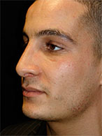 rhinoplastie avant après chirurgie esthétique nez Dr Weiss