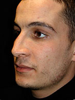 rhinoplastie avant après chirurgie esthétique nez Dr Weiss