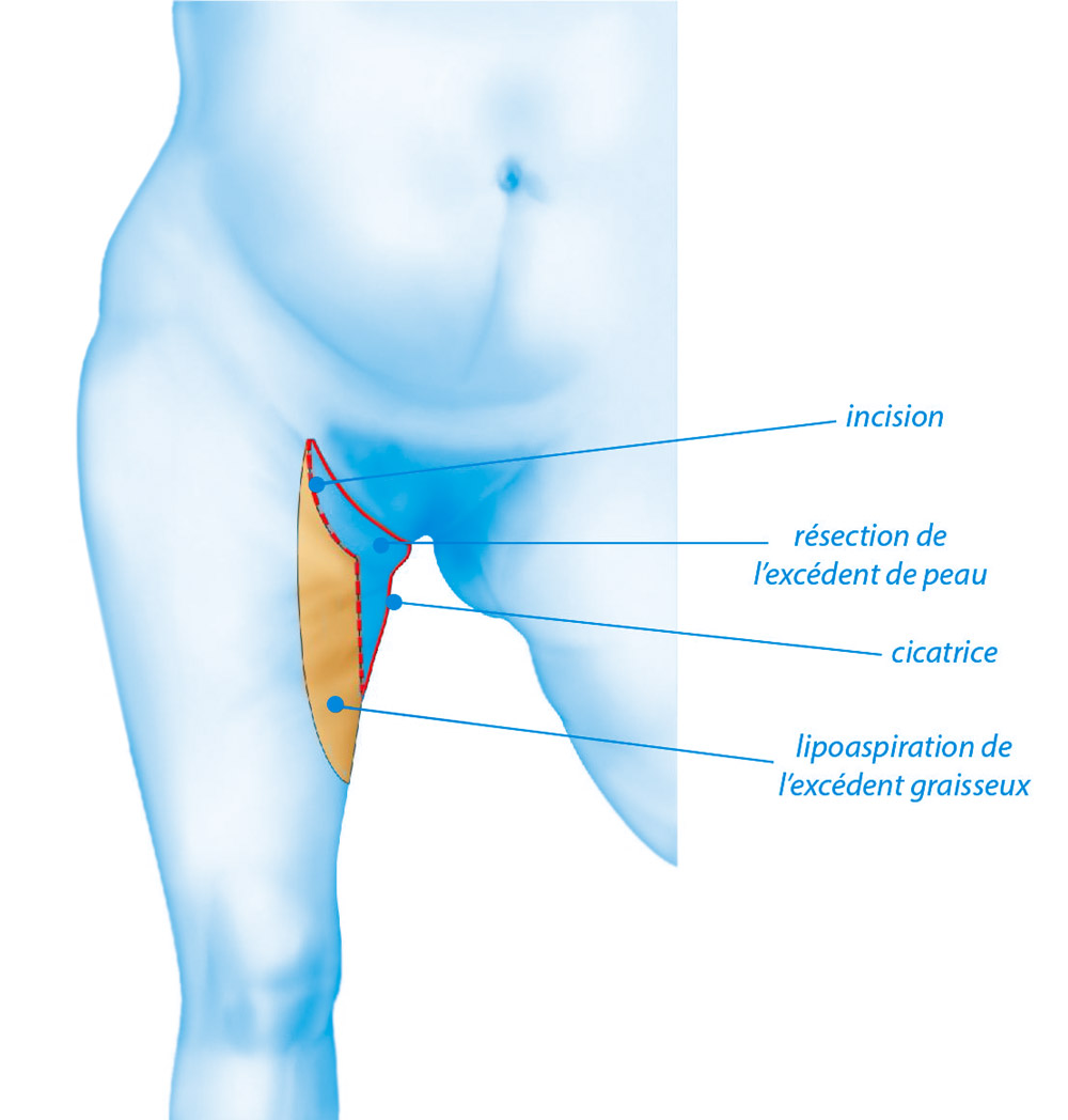 Chirurgie esthétique de la cruroplastie par le Docteur Weiss du CCEPO