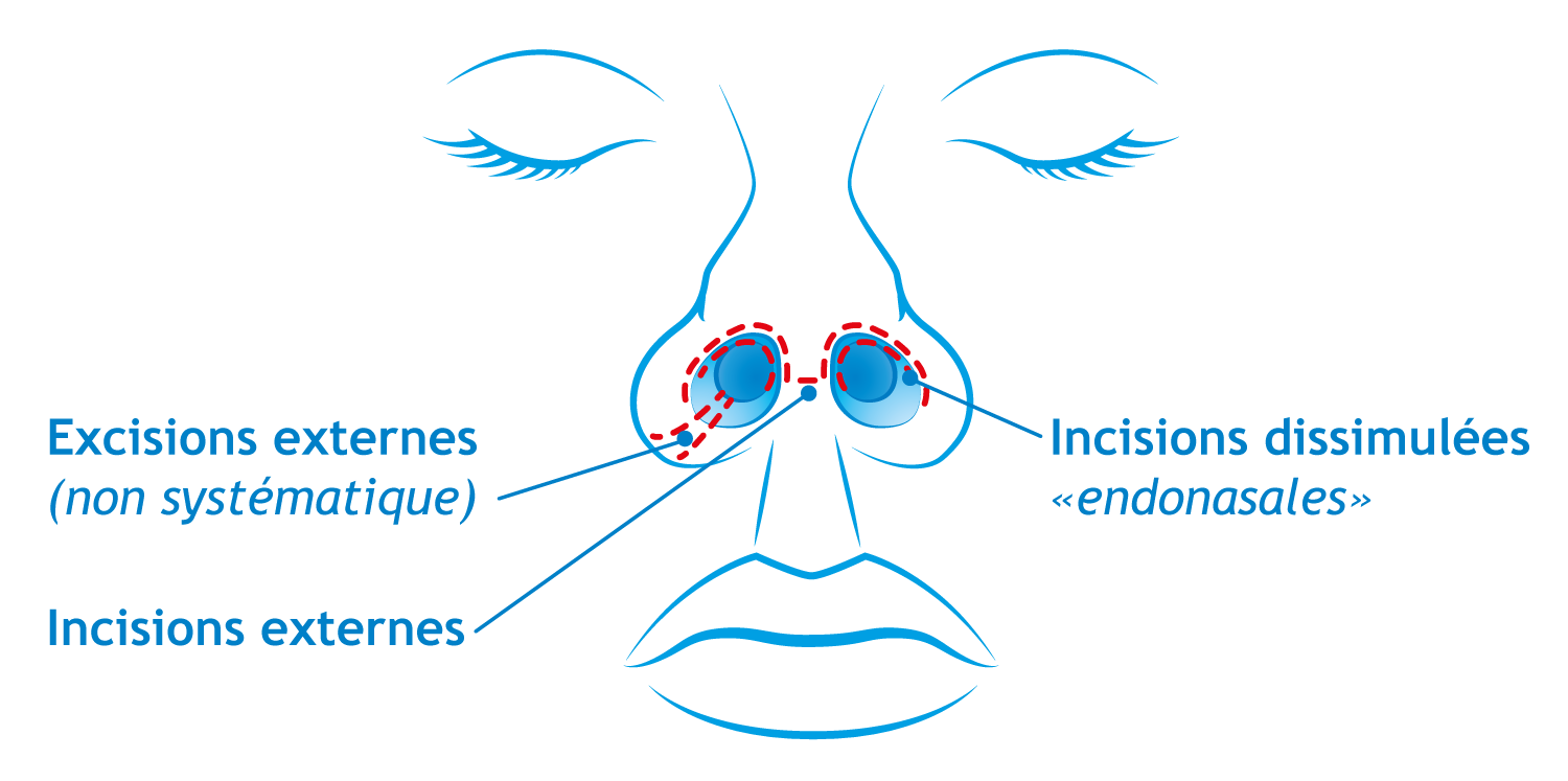 Rhinoplastie par Dr. WEISS